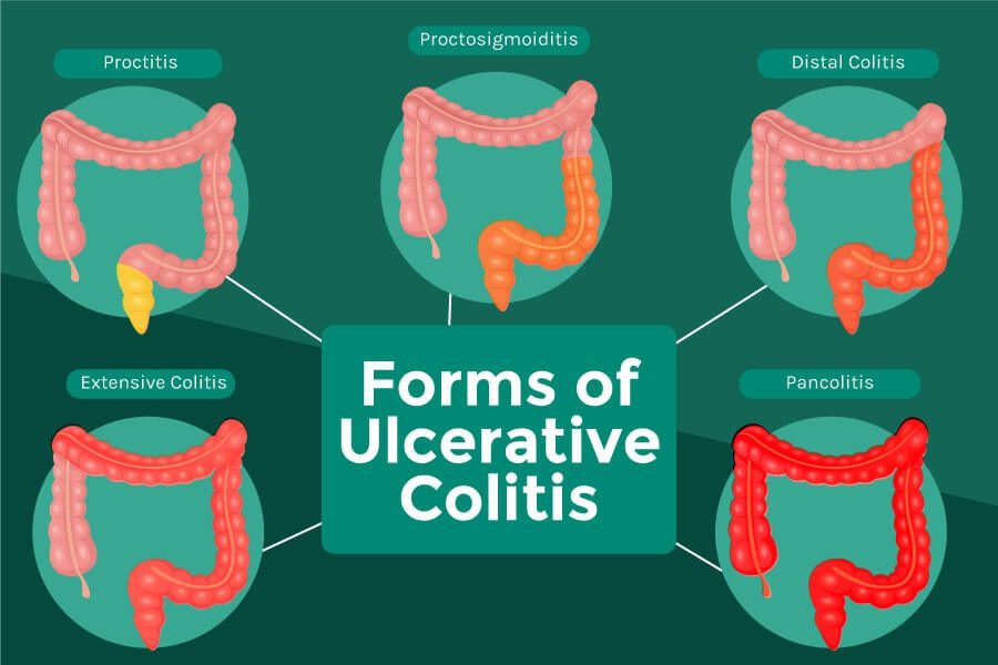 Ulcerative Colitis treatment in Ayurveda blogsadda