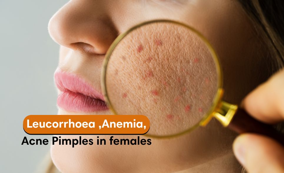 Leucorrhea ,Anemia ,Acne Pimples in females