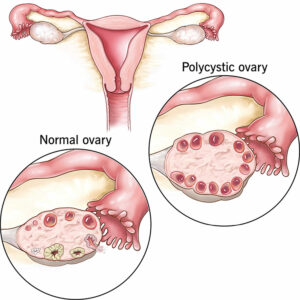 Polycystic Ovarian Disease