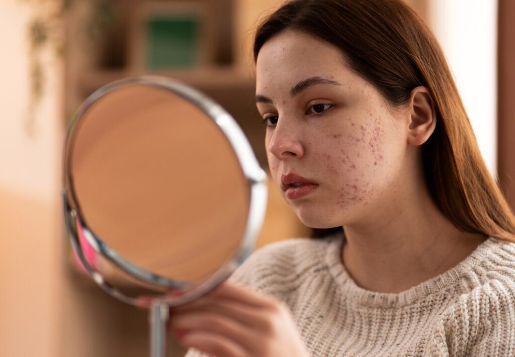 Ayurvedic Tips for Managing Monsoon Acne and Skin Infections Naturally